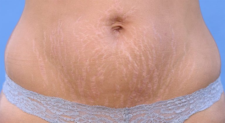 Cómo eliminar las estrías: remedios caseros que sí funcionan