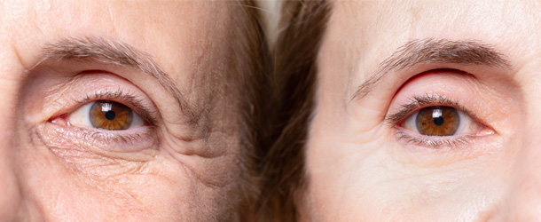 Qué es el bótox 140 Efecto y duración del bótox