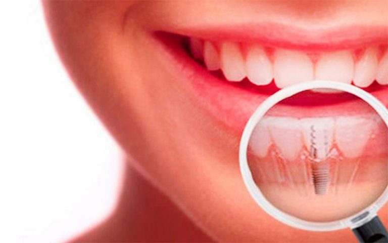 Implantes dentales ¿Cúal elegir?
