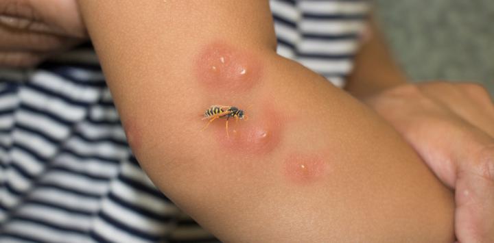 ¿Cómo conocer la picadura de una avispa?