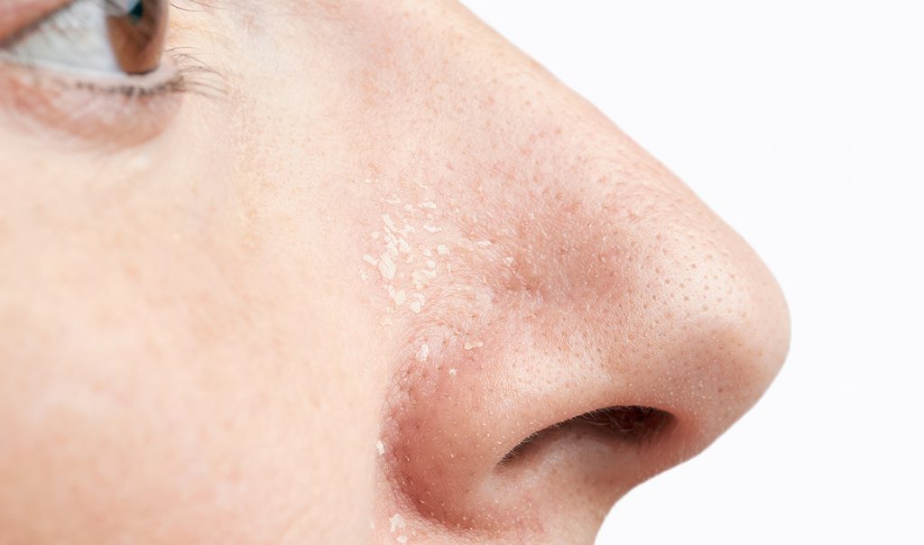 ¿Cómo puede la sobre hidratación ocasionar exceso de sequedad?