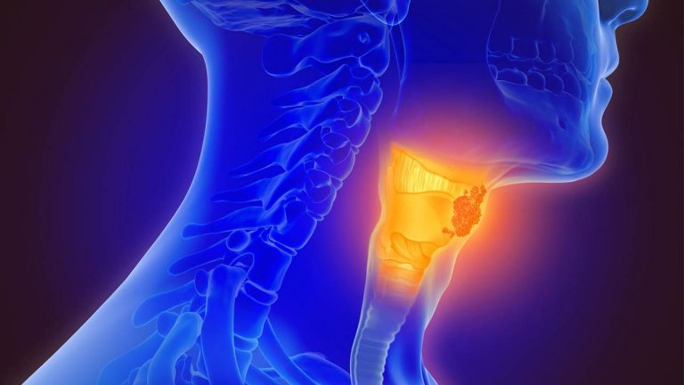 Qué es la faringitis