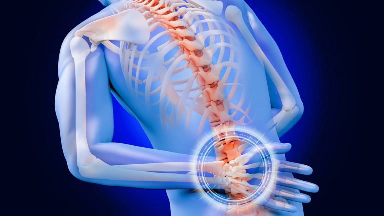 Qué es la hernia discal