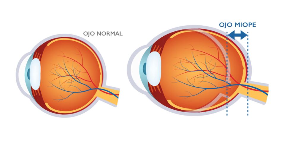 Qué es la miopía