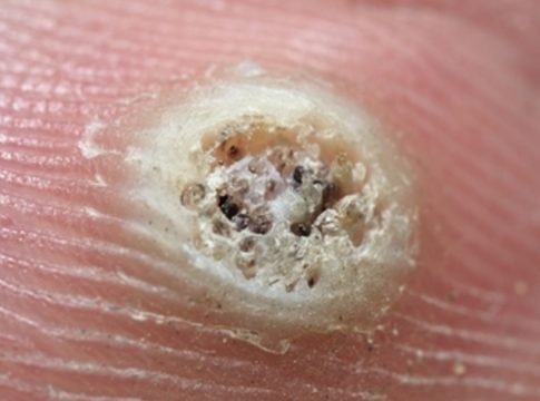 Qué es papiloma Qué es papiloma