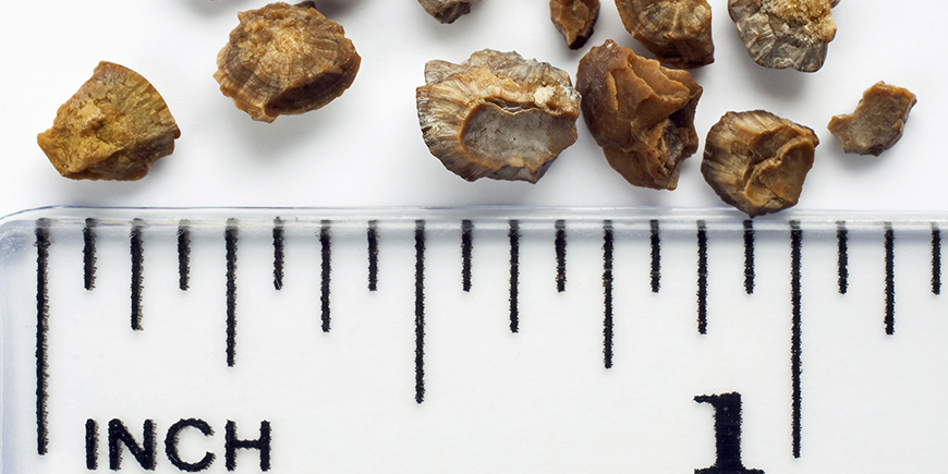 Qué es un cólico nefrítico 32 Qué es un cólico nefrítico