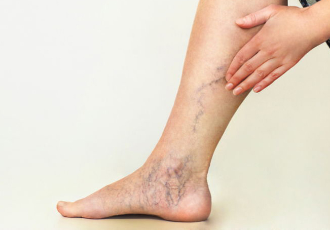 Cómo mejorar la circulación de las piernas 29 Síntomas de la mala circulación de las piernas