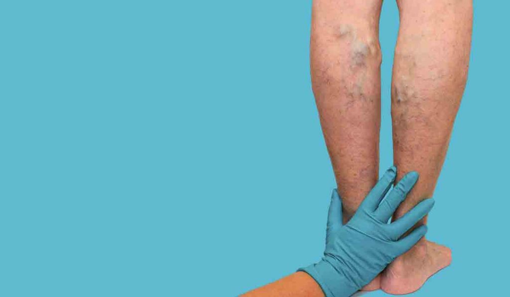 Evite los coágulos siguiendo estos consejos