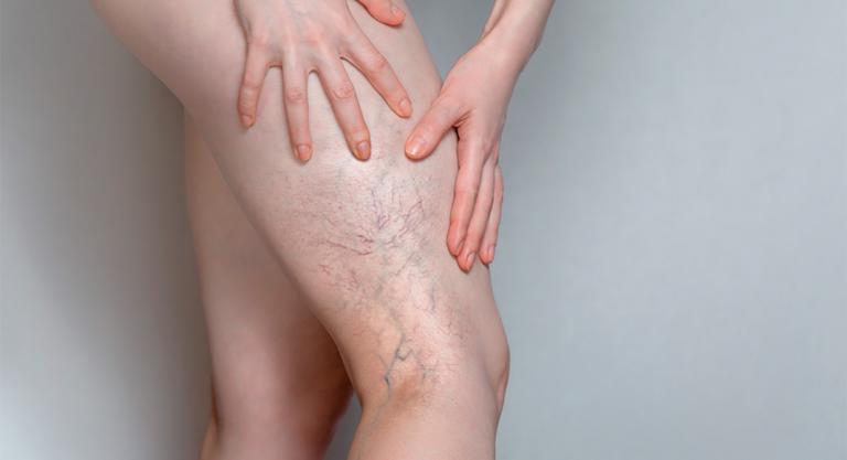 ¿Hay tratamiento para los trombos?