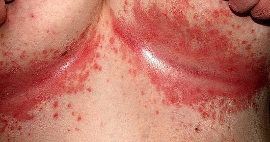 Tipos de candidiasis