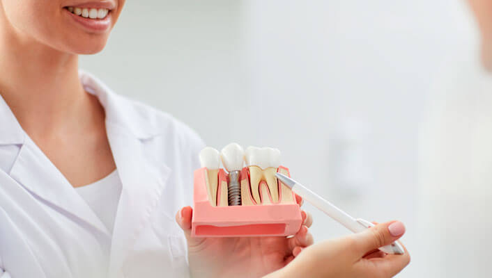 Qué es un implante dental 191 Tipos de implante dental