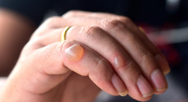 ¿Cómo saber si tengo una?