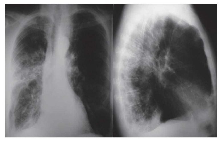Logran nuevos avances en aspergilosis pulmonar invasora