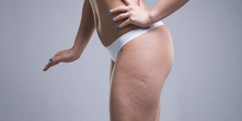 ¿Por qué aparece la celulitis?