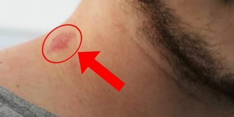 ¿Se puede quitar un chupetón?