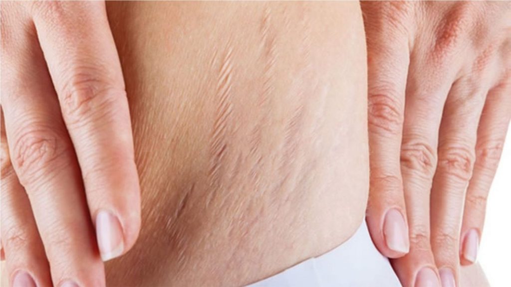 Cómo eliminar las estrías: remedios caseros que sí funcionan 51 Estrías, una marca natural en la piel