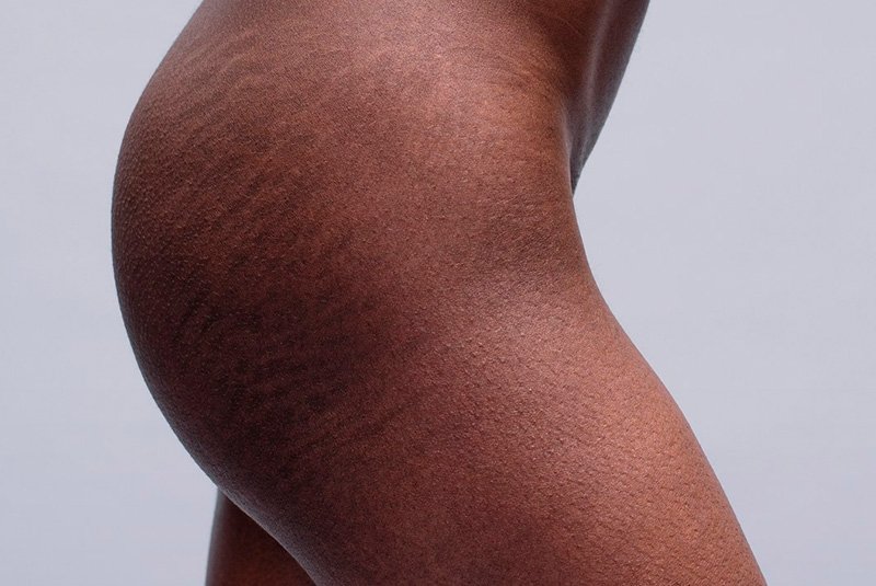 Cómo eliminar las estrías: remedios caseros que sí funcionan 53 ¿Y si los remedios caseros no funcionan?