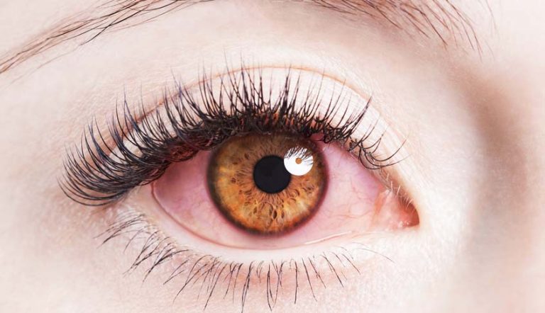 Un 44% de pacientes con síndrome de Sjögren tiene otras enfermedades autoinmunes sistémicas