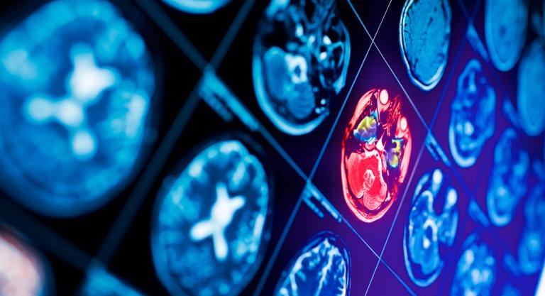 trombosis de senos venosos cerebrales