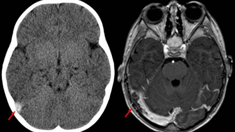 Qué es la trombosis de senos venosos cerebrales