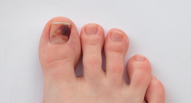 Cómo curar una uña morada 3 Datos a tomar en cuenta para evitar uñas moradas