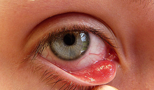 Cómo tratar un orzuelo 45 ¿Qué pasa cuándo el orzuelo es persistente?