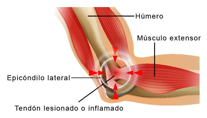 Cómo tratar el codo de tenista 1 El codo de tenista, un mal que puede atacar a cualquiera