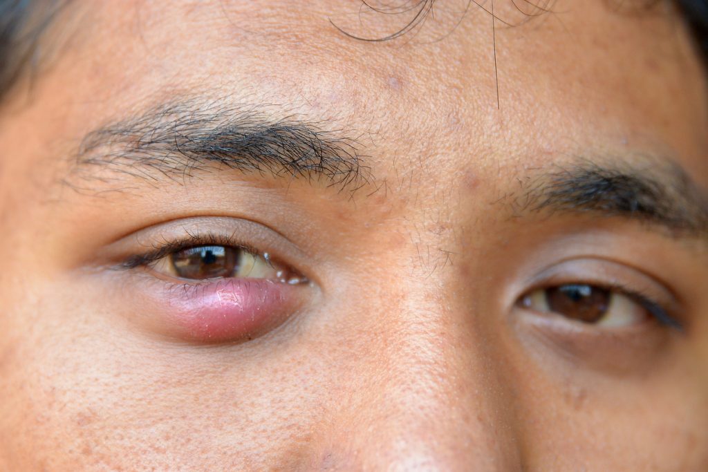 Cómo tratar un orzuelo 46 Tratamiento para la inflación del orzuelo