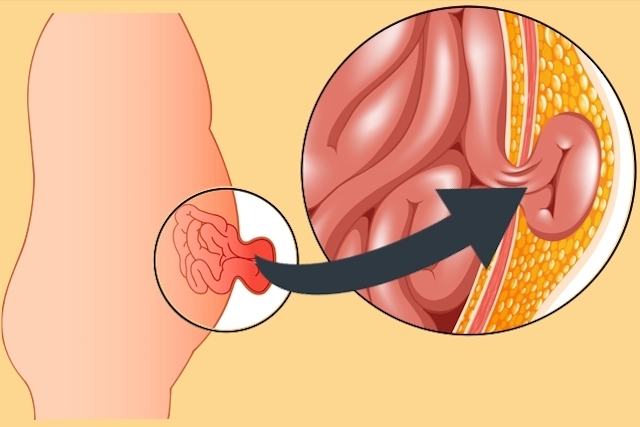 Cómo se trata una hernia abdominal 2 ¿Tener una hernia abdominal duele?