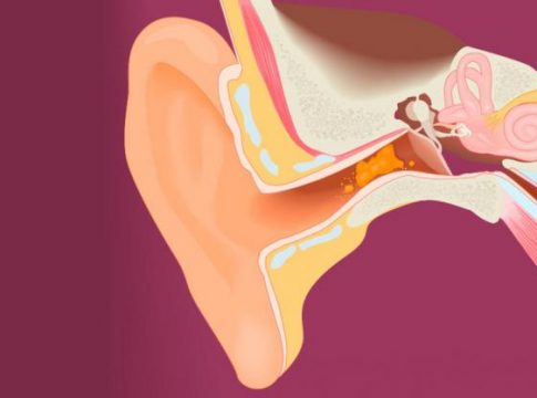 CERUMEN DE OÍDOS cerumen de oídos