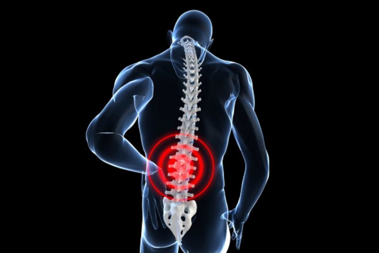 Cómo tratar la lumbalgia