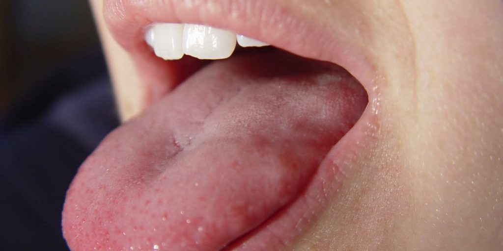 Enfermedades que puede transmitirte un beso 7 Mononucleosis infecciosa Enfermedades beso