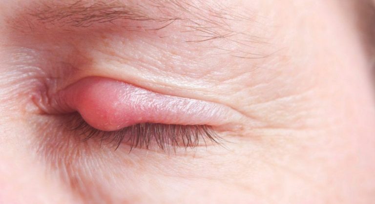 Cómo tratar un orzuelo