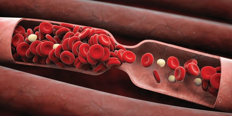Qué es VIPIT, el trastorno de la vacuna AstraZeneca