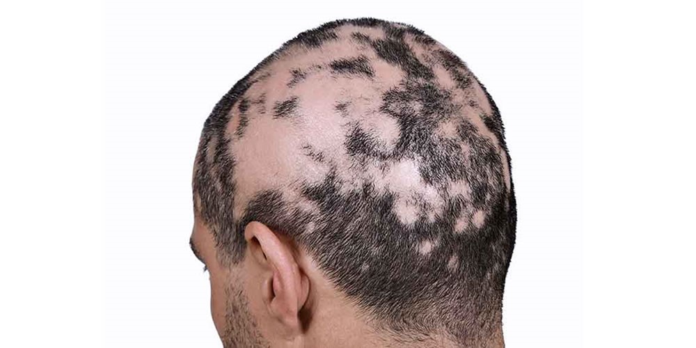 Qué es la alopecia 18 Qué es la alopecia
