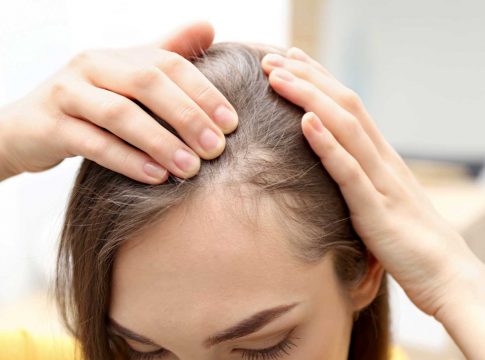 Qué es la alopecia Qué es la alopecia