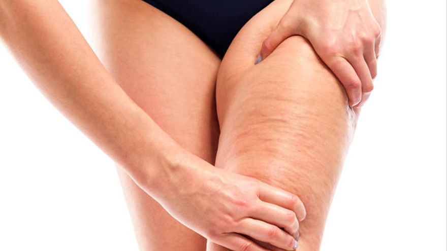 Celulitis: cómo tratarla y eliminarla de tu piel