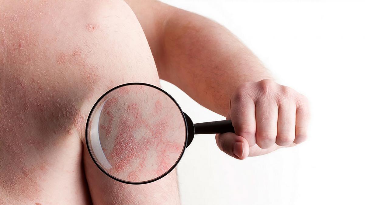Qué es la psoriasis 1 Qué es la psoriasis