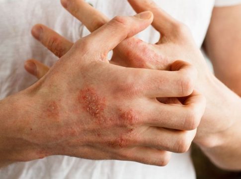 Qué es la psoriasis Qué es la psoriasis