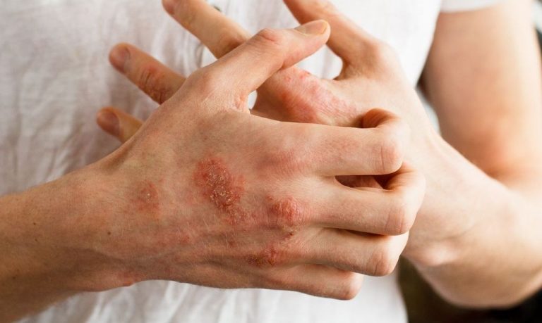 Qué es la psoriasis