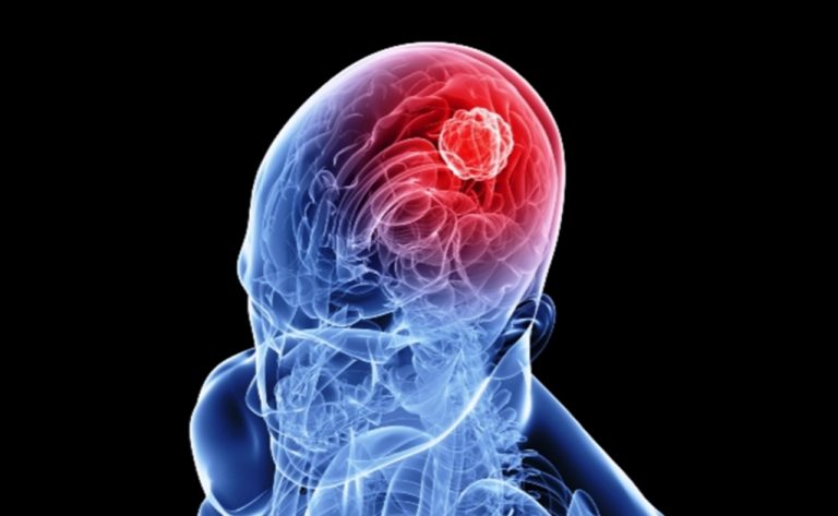 Qué es un infarto cerebral