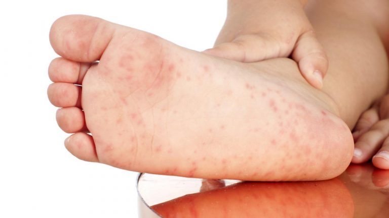 Qué son los sabañones