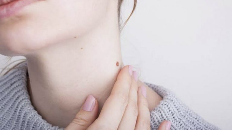 Verrugas: síntomas de alarma con los que debes acudir al medico