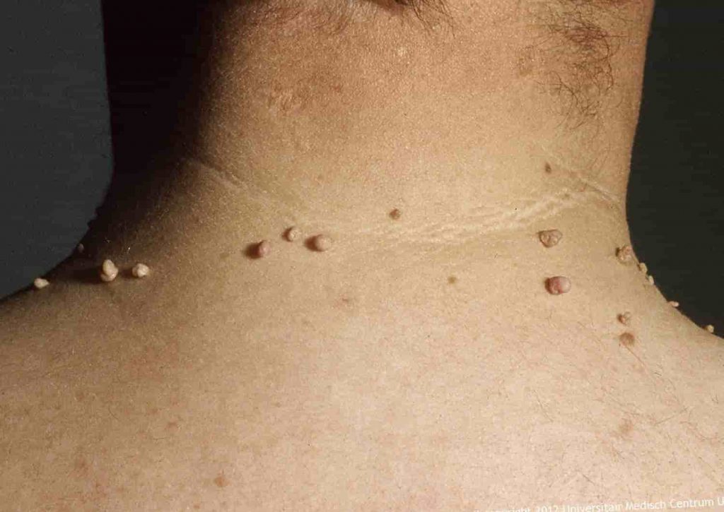 ¿Es posible que una verruga pueda provocar la aparición de otras?