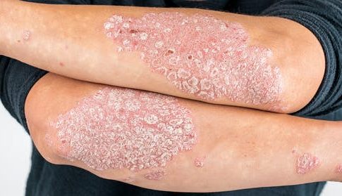 psoriasis Dermatólogos aseguran que no hay evidencia de que las vacunas afecten al curso de la psoriasis