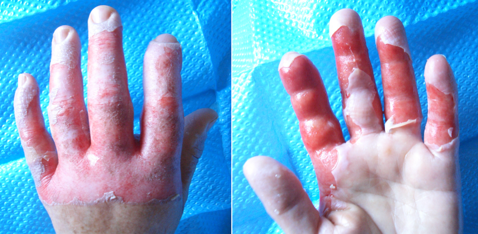 ¿Cuáles son los tipos de quemaduras?