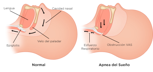 Tipos de apnea