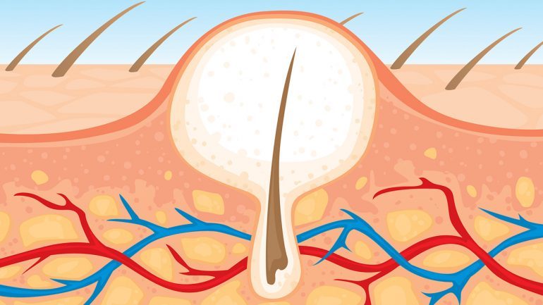 Cómo quitar un pelo encarnado 152 ¿Qué hacer para eliminar un pelo encarnado?