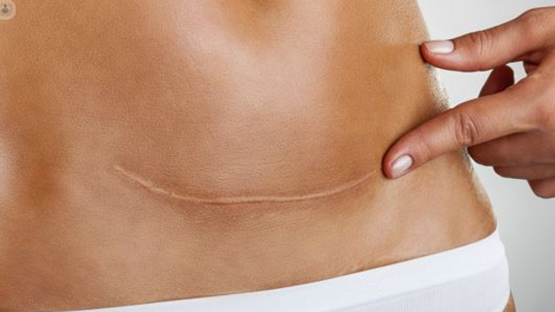 Remedios naturales para las cicatrices 