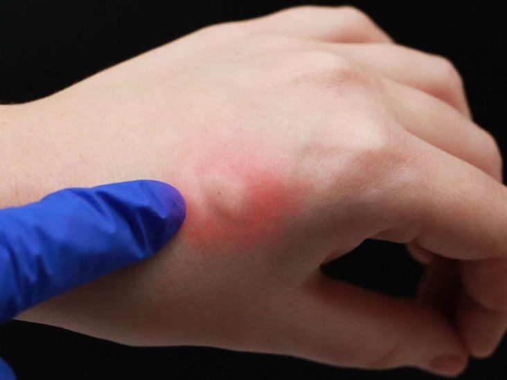 Trucos caseros para combatir a los mosquitos 